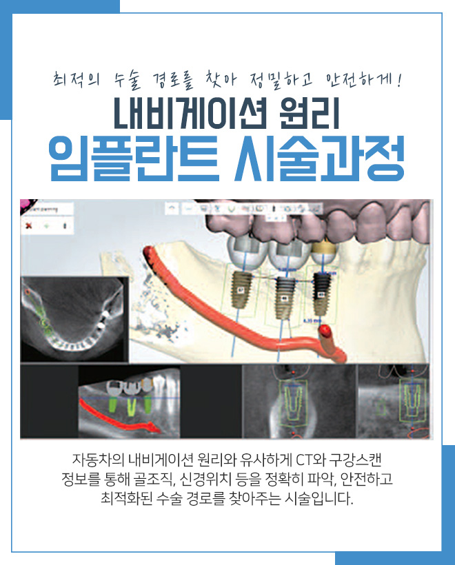 라임나무치과에서 부담 덜어낸 임플란트 받아보세요 관련 이미지 5