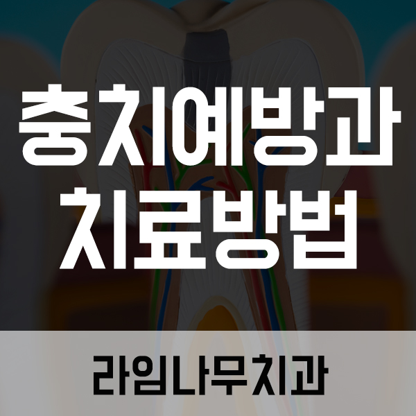 명동치과 충치예방과 치료방법에 대해 알아봐요 관련 이미지 1