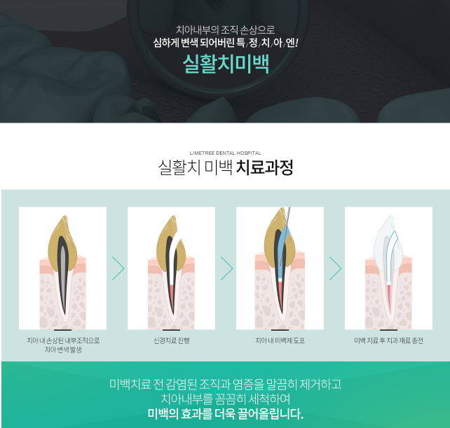 [라임나무치과] 치아 미백종류 어떤 것이 있을까? 관련 이미지 3