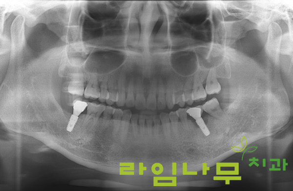 임플란트 재수술 증례! 믿을만한 곳 명동치과 라임나무치과 관련 이미지 5