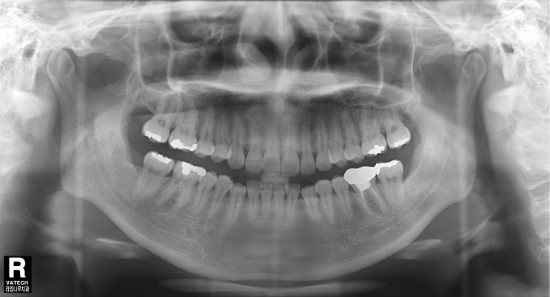 [의료진 교정일기]투명교정으로 아랫니 치열 바로잡기 관련 이미지 3