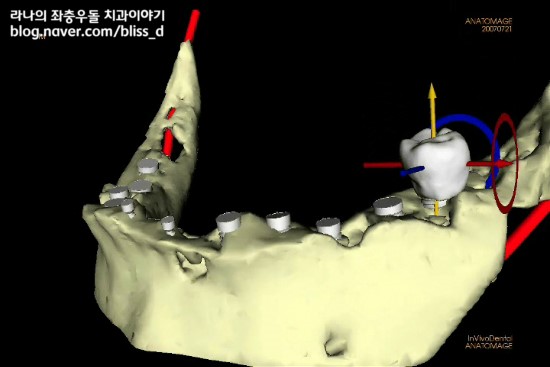 임플란트 치료시 x-ray, ct 촬영이 필요한 이유 관련 이미지 4