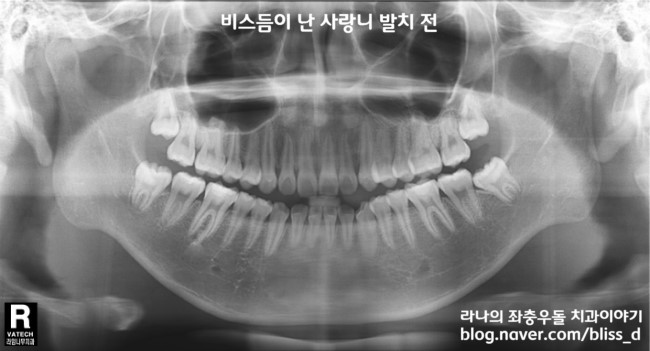 사랑니 발치 잘하는 명동치과 어디? 관련 이미지 4