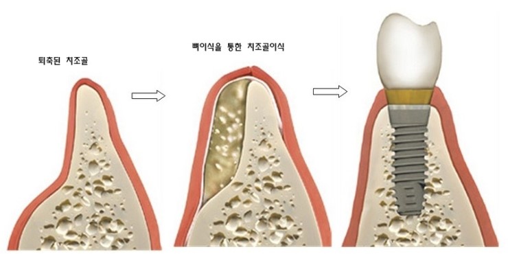 임플란트, 왜 필요할까요 관련 이미지 4