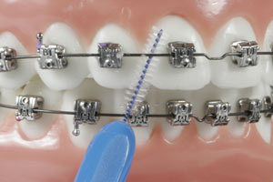 치아교정 중 양치질은 어떻게 하는 것이 좋을까 관련 이미지 5