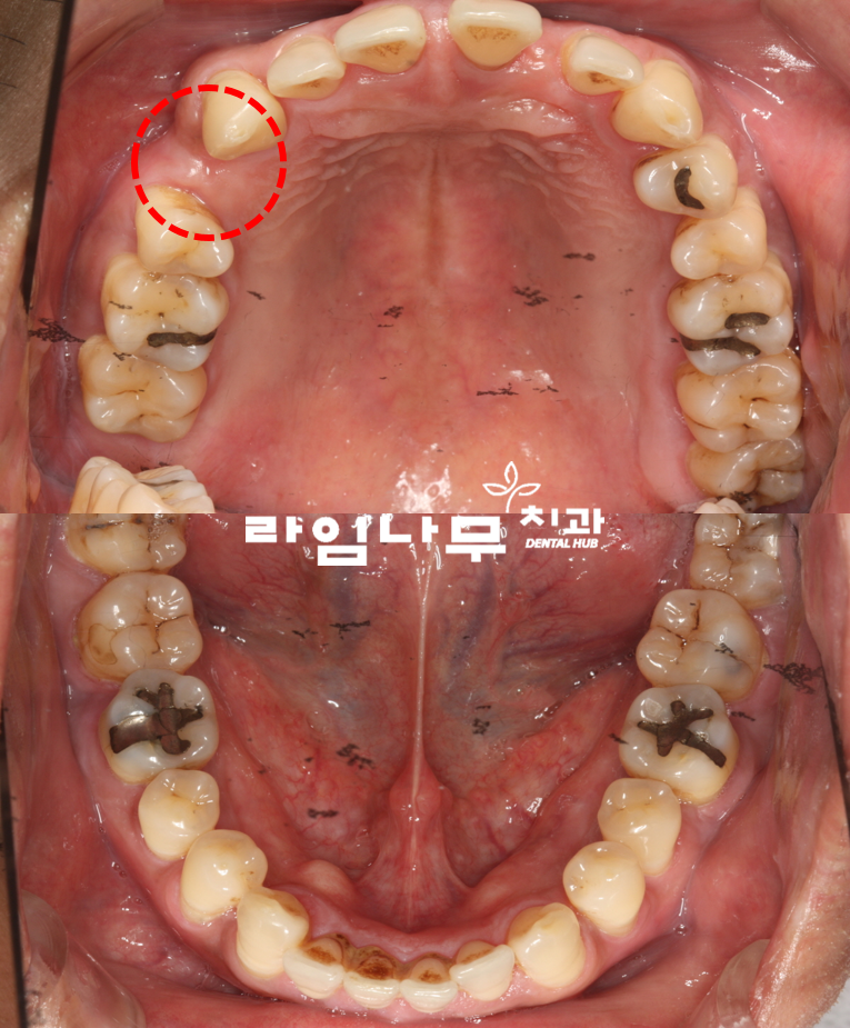 명동치과 전체임플란트 증례! 치주염으로 전체 치아의 기능을 상실한 치아 관련 이미지 3