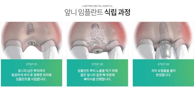 [명동치과] 앞니 임플란트 치과 고르는 방법 관련 이미지 3