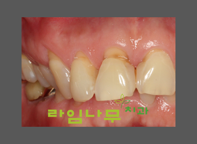 치경부마모증, 잇몸올라가 시리다면? 명동치과 라임나무 관련 이미지 2