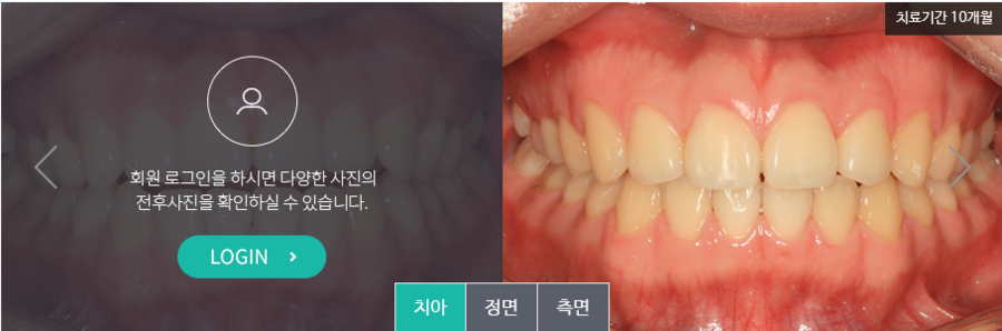 [명동 역삼 라임나무치과] 치아교정, 이런 분들께 꼭 필요해요! 관련 이미지 3