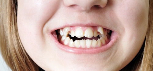 덧니의 정의와 덧니 교정방법 관련 이미지 3