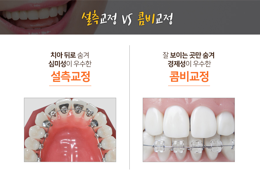 치아교정, 장치의 종류와 비용 알아보기 관련 이미지 3