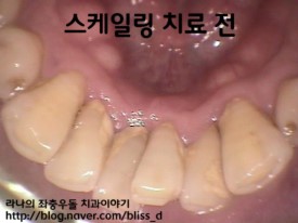 스케일링 건강(의료)보험적용 7월1일부터 시작! 관련 이미지 3