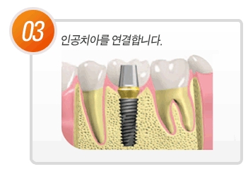 임플란트 골융합이 중요한 이유 관련 이미지 4