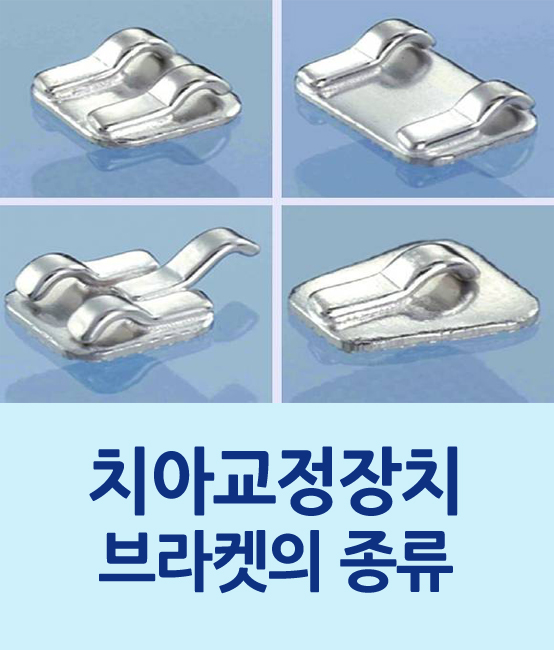 한 눈에 보는 치아교정 - 치아교정 장치의 종류 관련 이미지 1