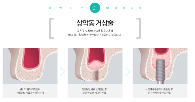 임플란트 기간 얼마나 걸릴까? 임플란트 뼈이식, 임플란트 종류 관련 이미지 2