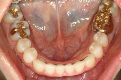 [의료진 교정일기]투명교정으로 아랫니 치열 바로잡기 관련 이미지 6