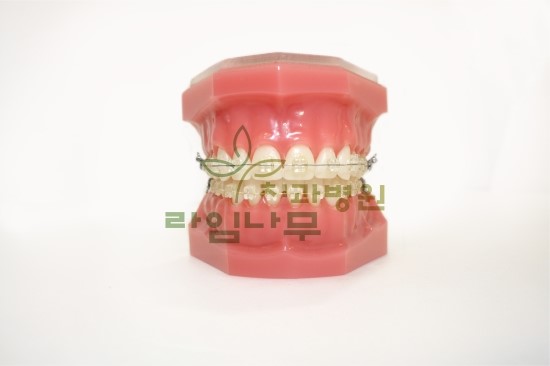 삐뚤어진 앞니나 벌어진 치아 부분치아교정으로 해결해보는건 어떨까? 관련 이미지 1
