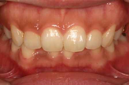 [명동 역삼 라임나무치과] 치아교정, 이런 분들께 꼭 필요해요! 관련 이미지 8