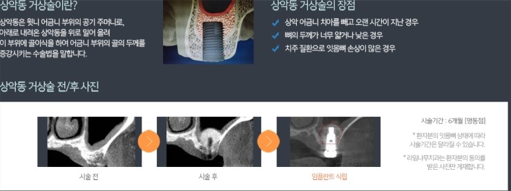 라임나무치과의 임플란트 솔루션을 소개합니다. 관련 이미지 6