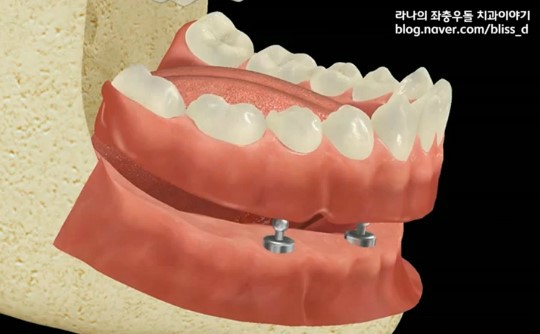 임플란트 틀니가 틀니보다 나은 이유 3가지 관련 이미지 7