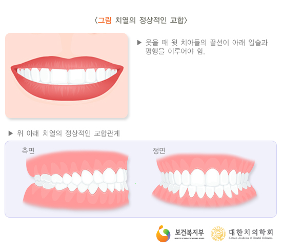부정교합이란 무엇이며, 어떻게 치료할 수 있을까요 관련 이미지 2
