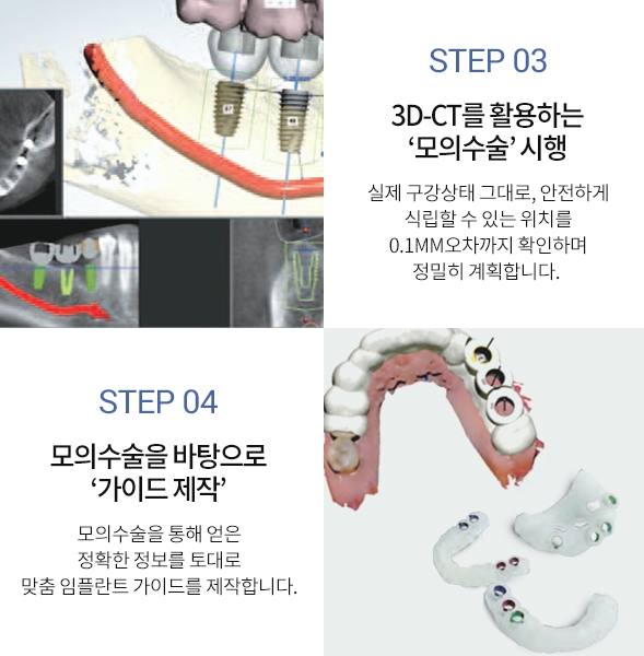 통증은 적고 시술은 빠른 라임나무치과 "네비게이션원리임플란트" 관련 이미지 4