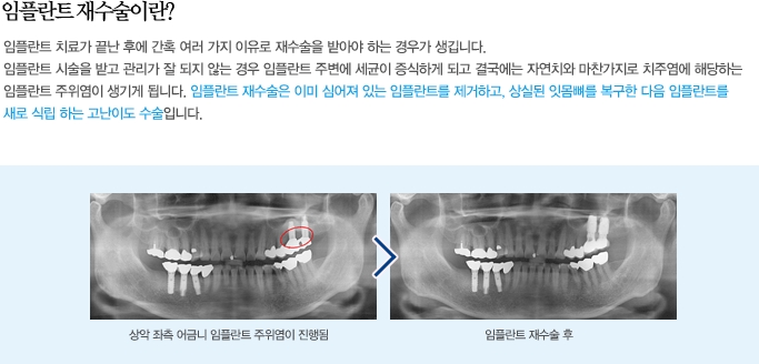 임플란트 재수술 증례! 믿을만한 곳 명동치과 라임나무치과 관련 이미지 2