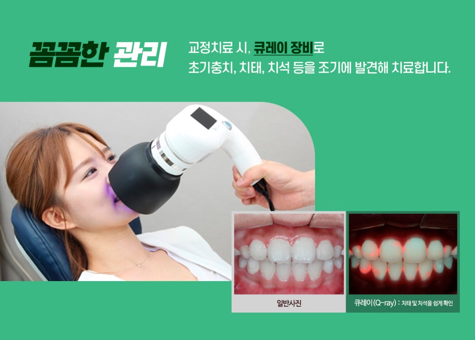 치아교정 시작 전, 알아둬야 할 체크포인트 관련 이미지 4