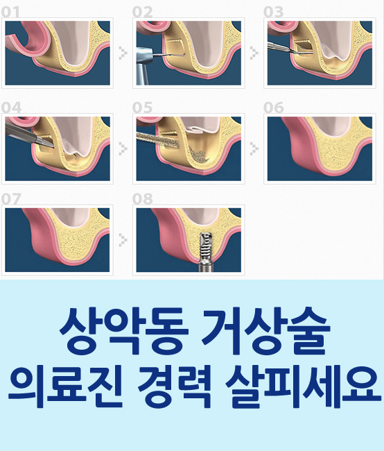 상악동 거상술 임플란트, 의료진의 경력 꼭 챙기세요 관련 이미지 1