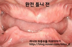 노인 틀니 건강보험 적용 되시는것 알고 계세요 ? 관련 이미지 2