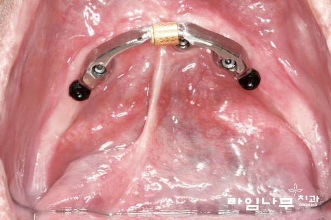 치아가 없다면? 치매 확율이 UP! 틀니임플란트로 해결보세요~ 관련 이미지 5