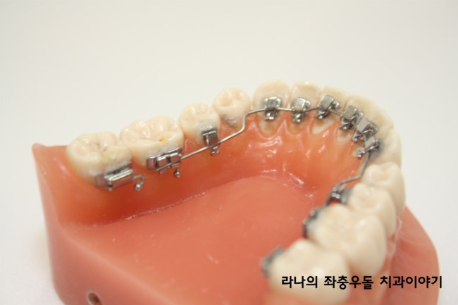 연예인들이 하는 치아교정? 연예인 치아교정 대세를 알아보자 관련 이미지 5