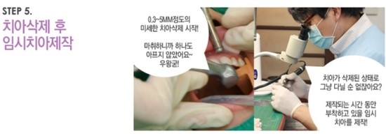 한 눈에 보는 라미네이트 : 라미네이트 치료 진행과정 관련 이미지 6