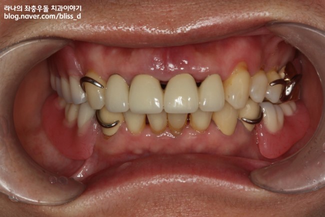 부분틀니 건강보험 적용! 7월 1일 부터 만75세 이상 노인분들 관련 이미지 2