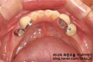 부분틀니 건강보험 적용, 부분틀니 가격은? 관련 이미지 3