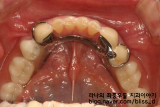 부분틀니 건강보험 적용, 부분틀니 가격은? 관련 이미지 4