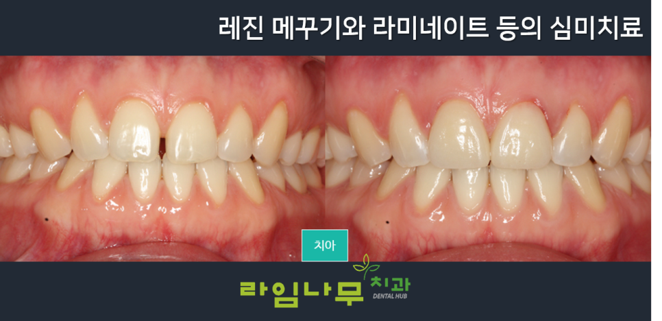 명동치과 잇몸 사이 틈? 치아 공간이 신경 쓰여요. 블랙트라이앵글/라임나무치과 관련 이미지 5