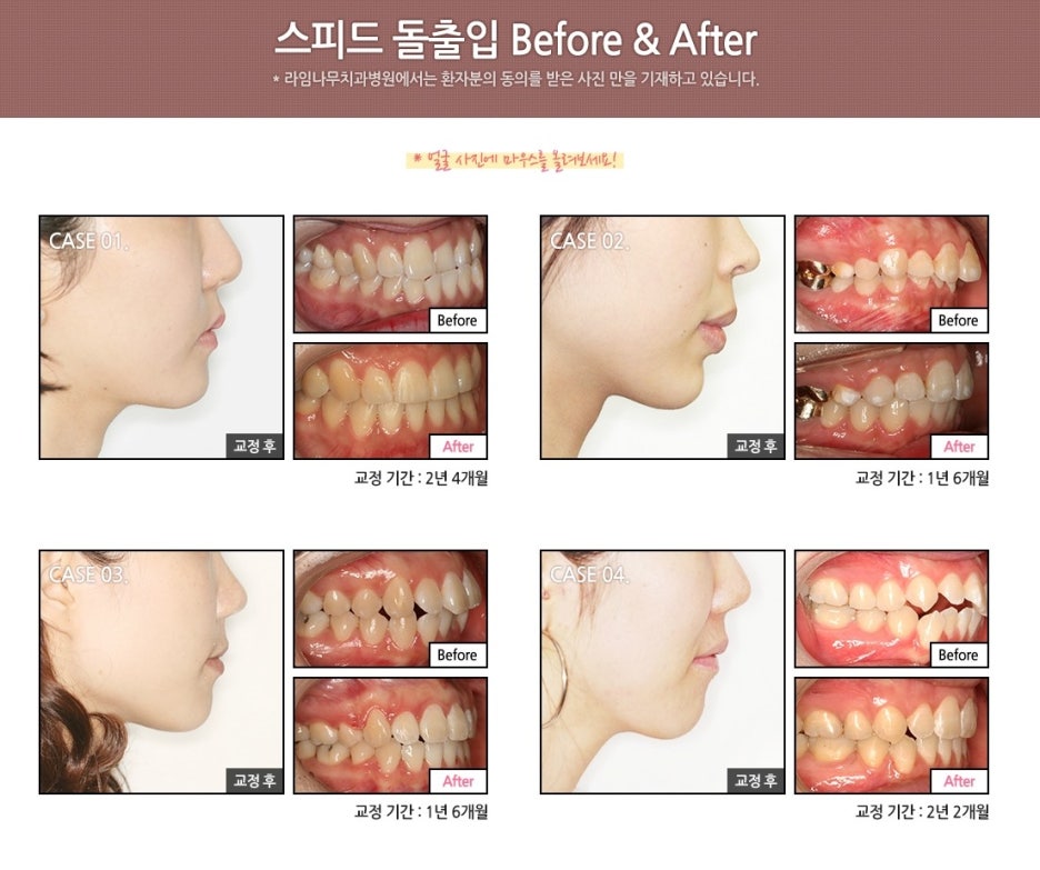 [명동치과]돌출입 때문에 고민중이시라고요? 라임나무에서 교정하세요 관련 이미지 3