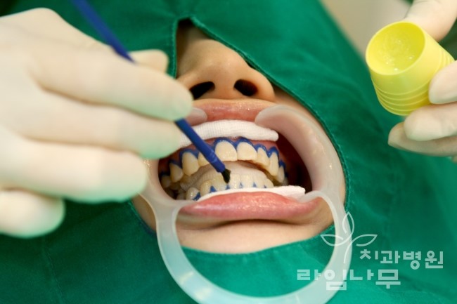 알아야 산다! 치아미백 부작용 어떤게 있을까? 관련 이미지 6