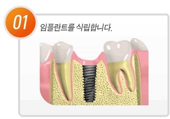 임플란트 골융합이 중요한 이유 관련 이미지 2