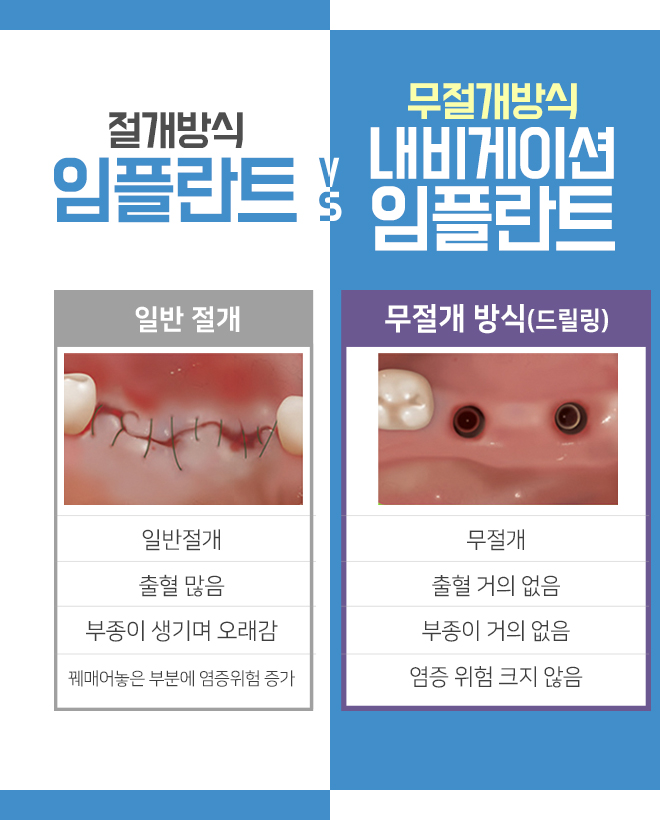 라임나무치과에서 부담 덜어낸 임플란트 받아보세요 관련 이미지 7