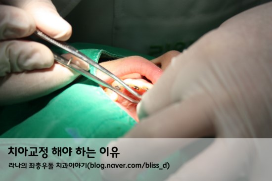 치아교정을 해야 하는 이유 관련 이미지 1