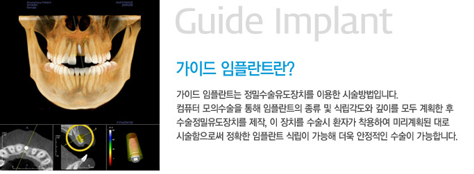 [명동치과 라임나무]오스템 임플란트 시술, 라임나무와 함께하세요 관련 이미지 5