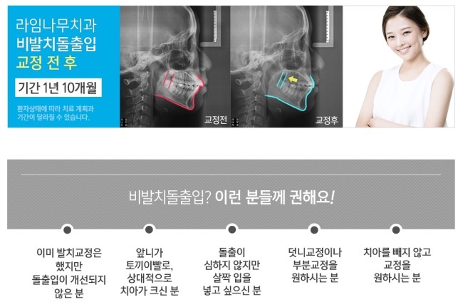 비발치 돌출입 교정 어떻게 가능할까요? 관련 이미지 4