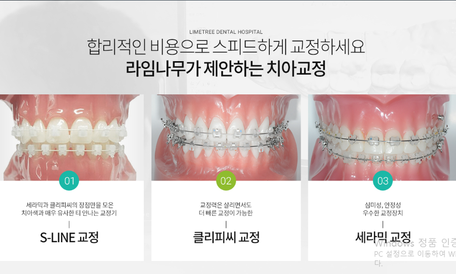 치아교정 장치 종류 (세라믹,클리피씨,에스라인교정) 관련 이미지 2