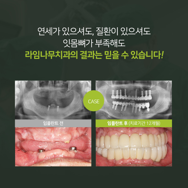 부모님 추석선물로 명동 치과 임플란트 관련 이미지 3