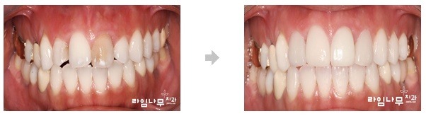 앞니에 충치가 생겼을 때의 다양한 치료 방법 관련 이미지 2