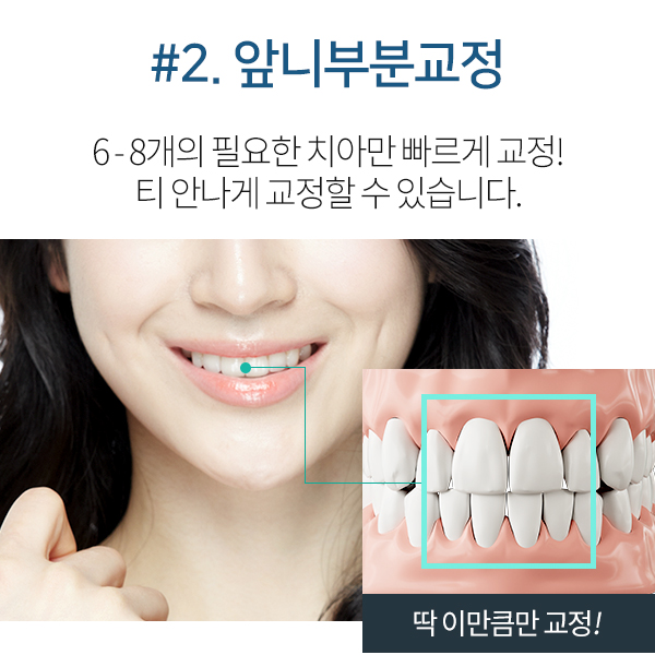 치아사이벌어짐, 라미네이트? 부분교정? 선택은! 관련 이미지 5