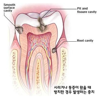 치아통증 원인 어떤게 있을까? 관련 이미지 2
