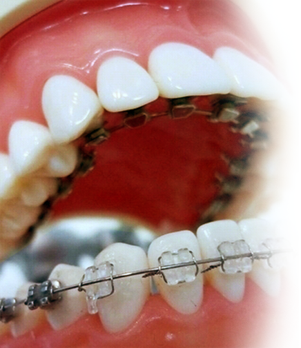 부정교합이란 무엇이며, 어떻게 치료할 수 있을까요 관련 이미지 10